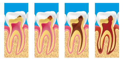 Les caries à Pontoise